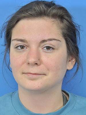 Scar Treatment Before & After