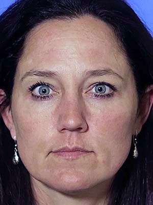 Chemical Peel Before & After