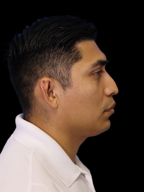 Rhinoplasty Before & After