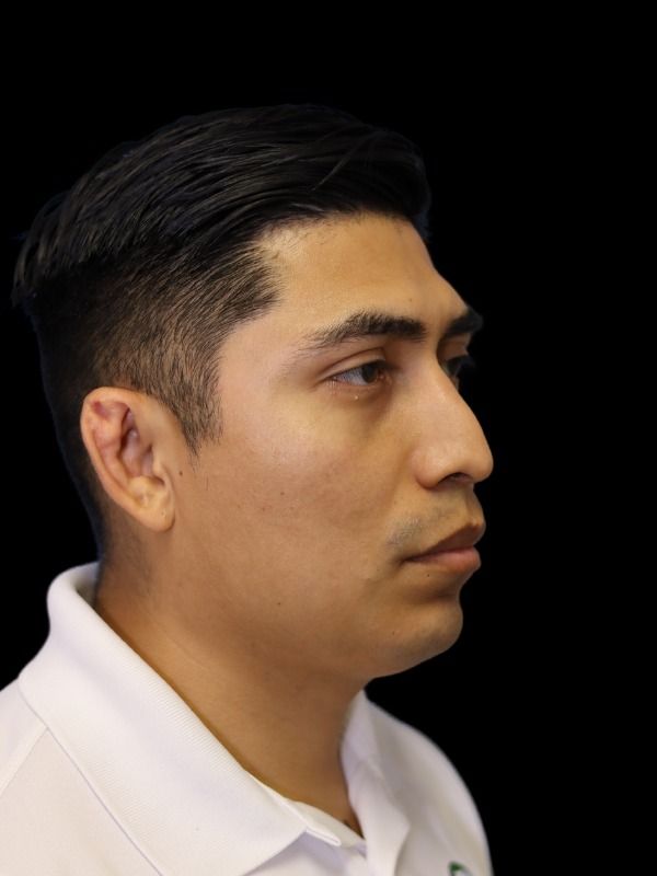 Rhinoplasty Before & After