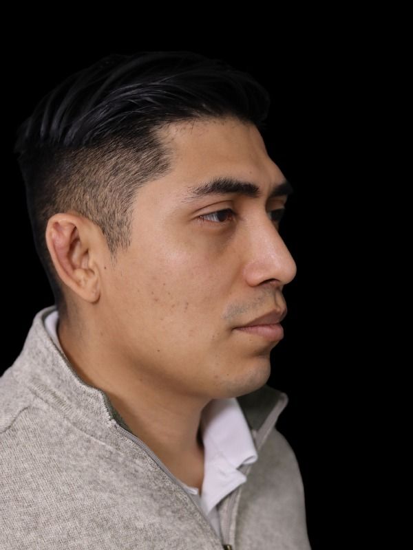 Rhinoplasty Before & After