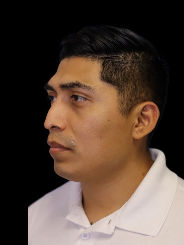 Rhinoplasty Before & After