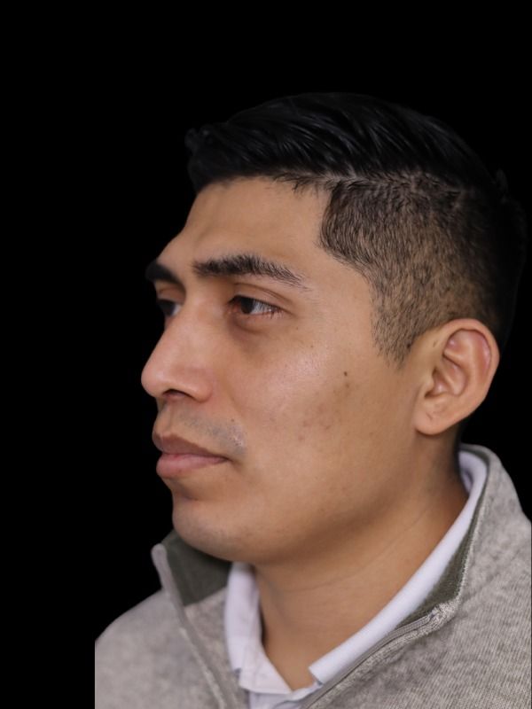 Rhinoplasty Before & After