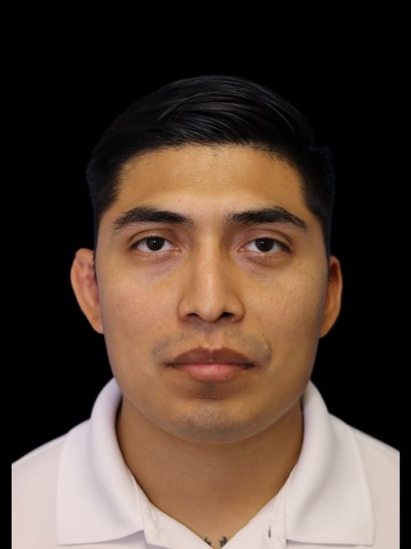 Rhinoplasty Before & After