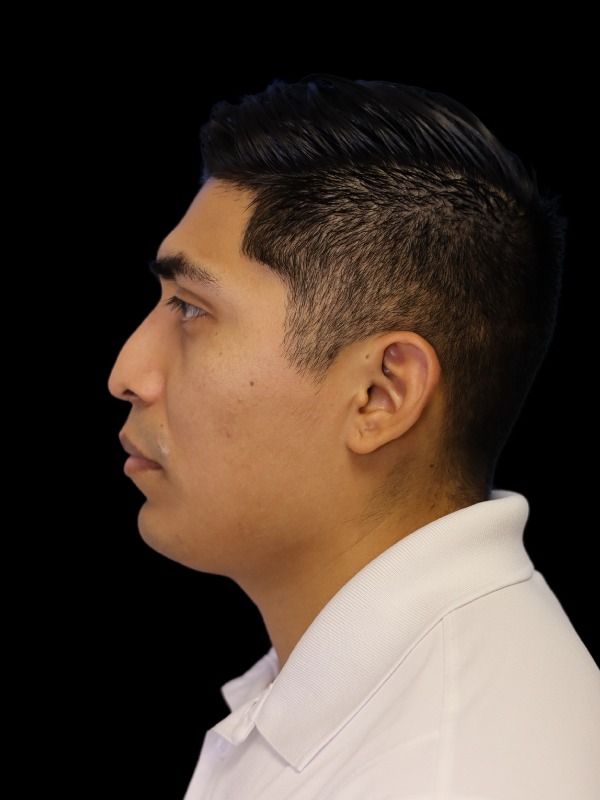 Rhinoplasty Before & After
