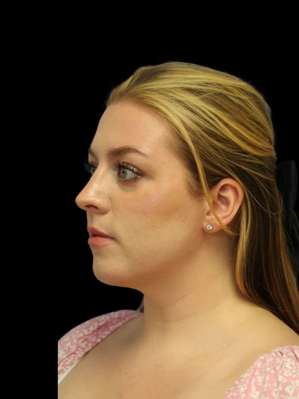Rhinoplasty Before & After