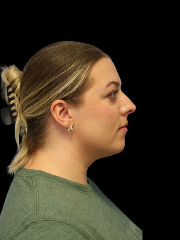 Rhinoplasty Before & After