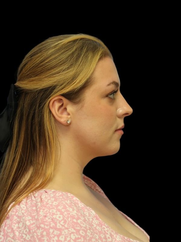 Rhinoplasty Before & After