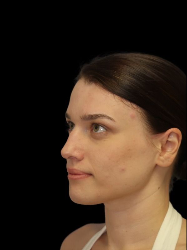 Rhinoplasty Before & After