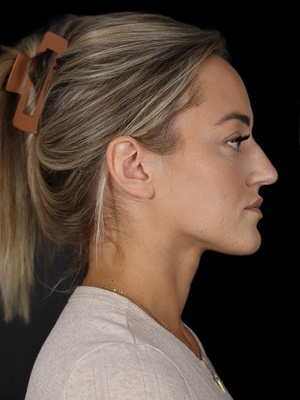 Rhinoplasty Before & After