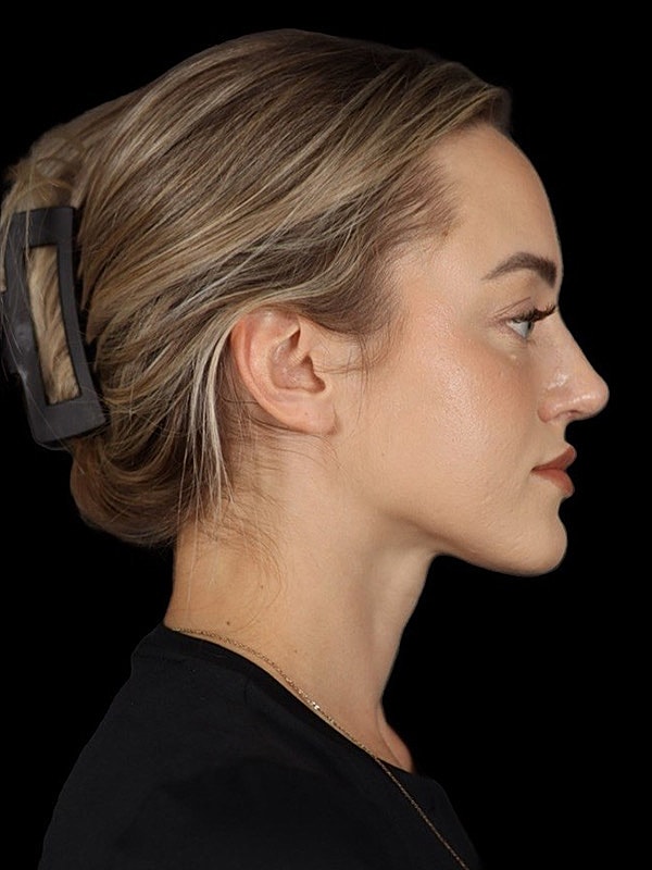 Rhinoplasty Before & After