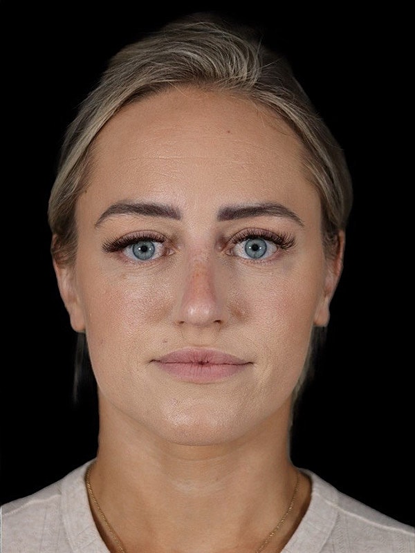 Rhinoplasty Before & After