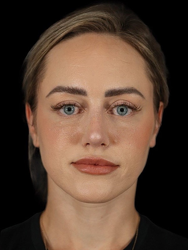 Rhinoplasty Before & After