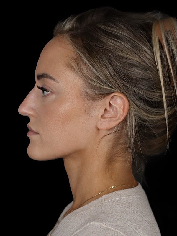 Rhinoplasty Before & After