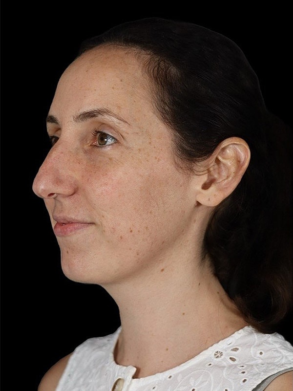 Rhinoplasty Before & After