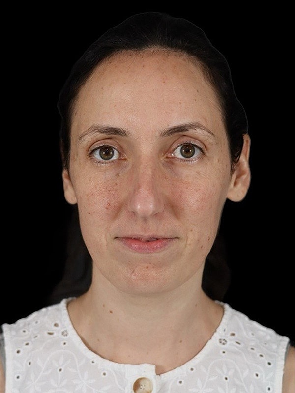 Rhinoplasty Before & After