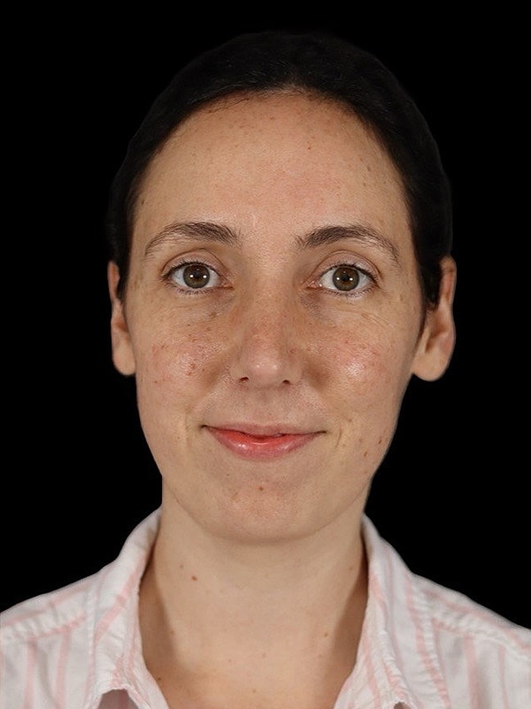 Rhinoplasty Before & After