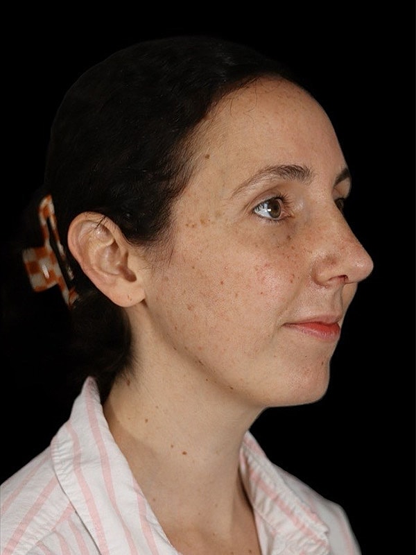 Rhinoplasty Before & After