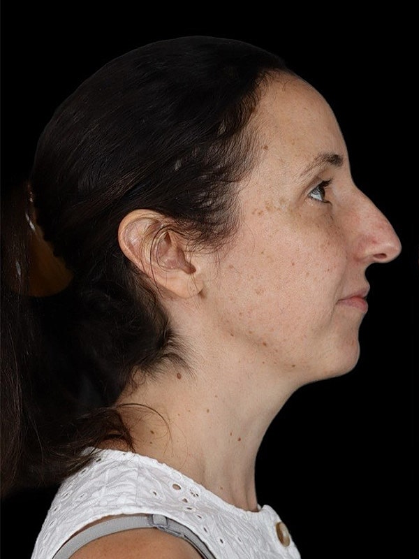 Rhinoplasty Before & After