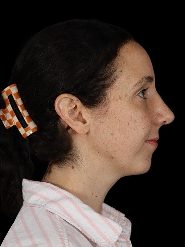 Rhinoplasty Before & After