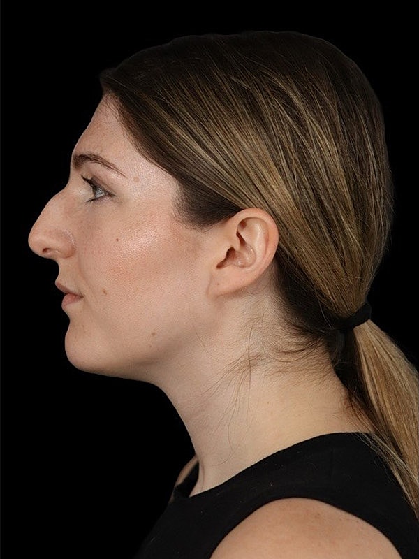Rhinoplasty Before & After