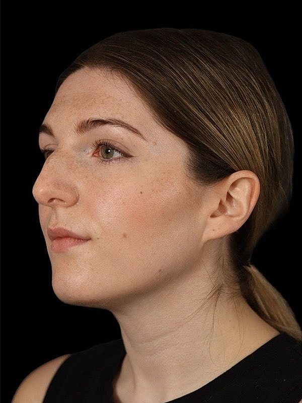 Rhinoplasty Before & After