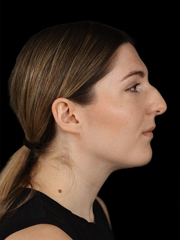 Rhinoplasty Before & After