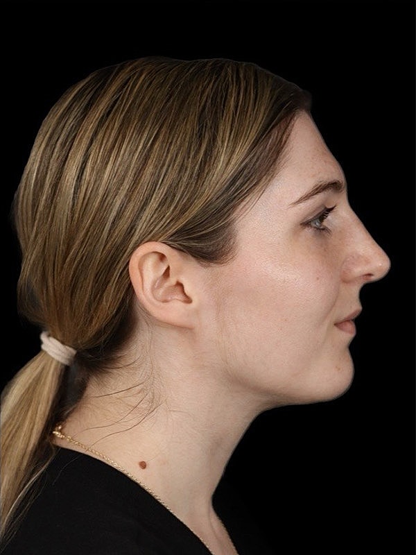 Rhinoplasty Before & After