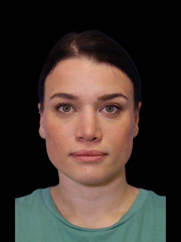 Rhinoplasty Before & After