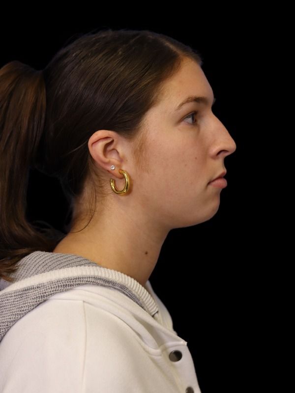 Rhinoplasty Before & After