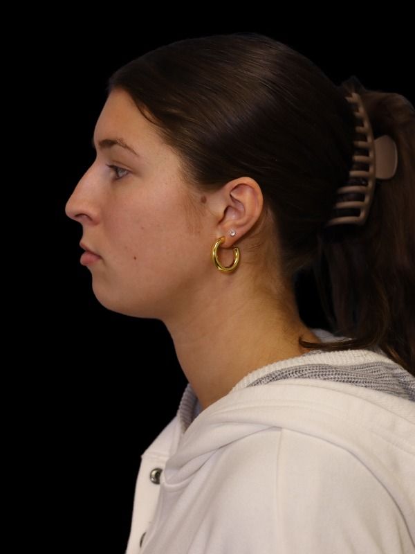 Rhinoplasty Before & After