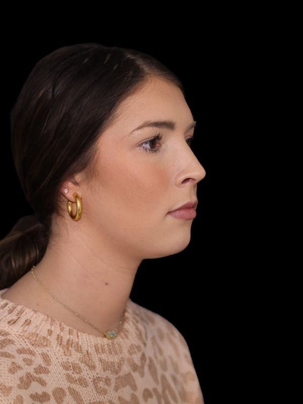 Rhinoplasty Before & After