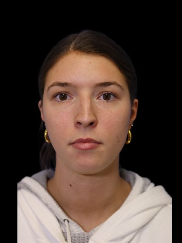 Rhinoplasty Before & After