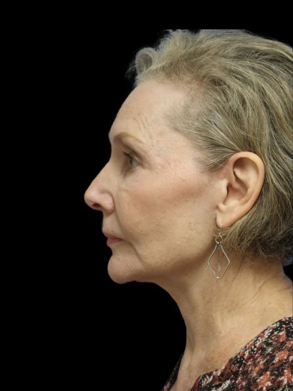 Rhinoplasty Before & After