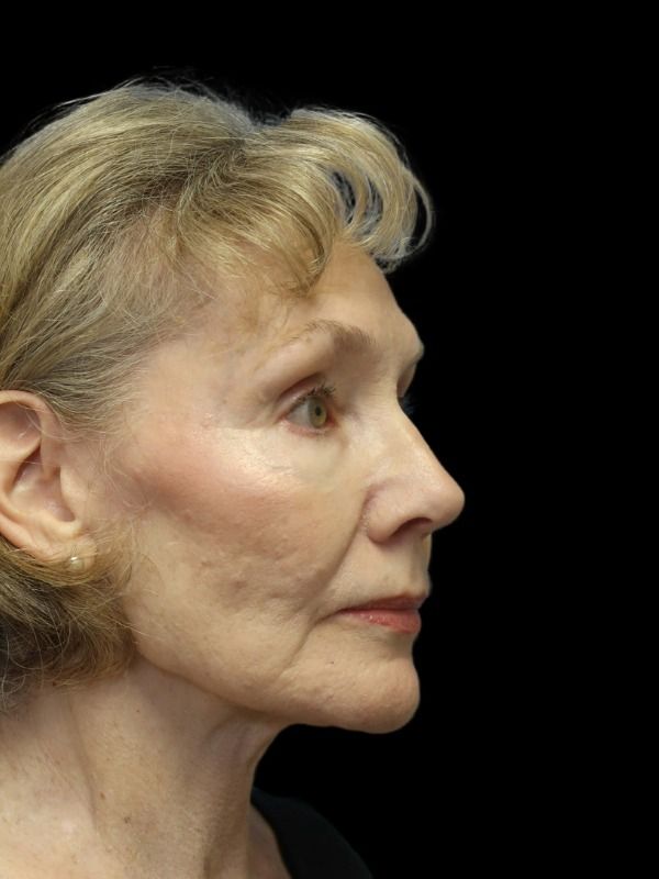 Rhinoplasty Before & After