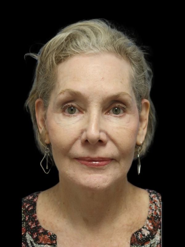 Rhinoplasty Before & After