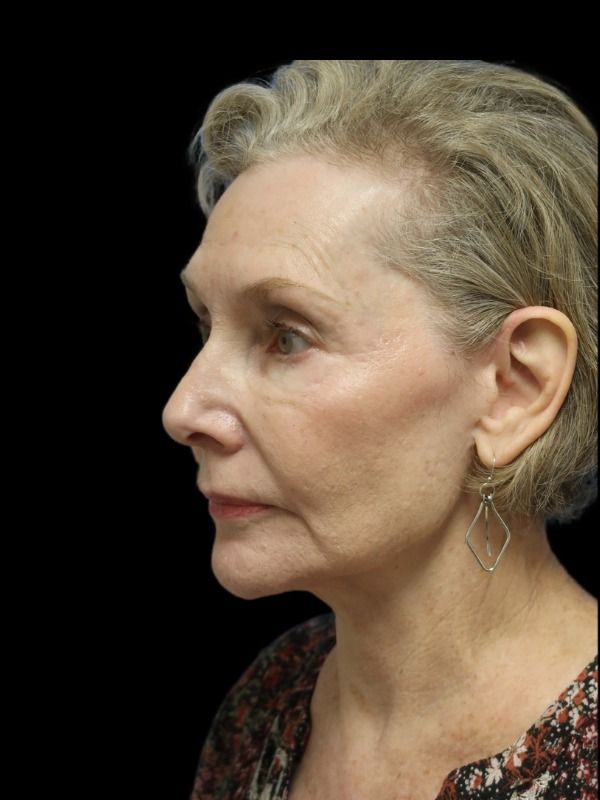 Rhinoplasty Before & After