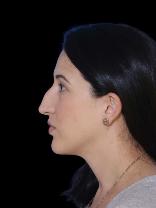 Rhinoplasty Before & After