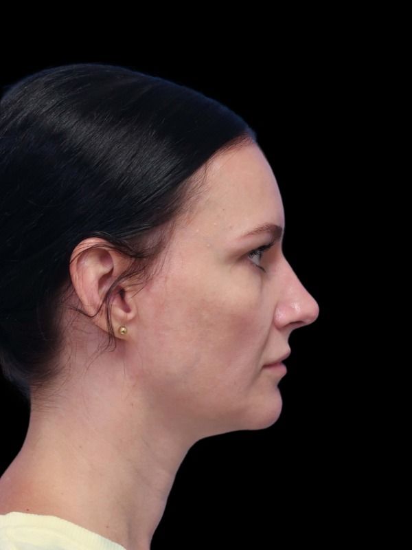 Rhinoplasty Before & After
