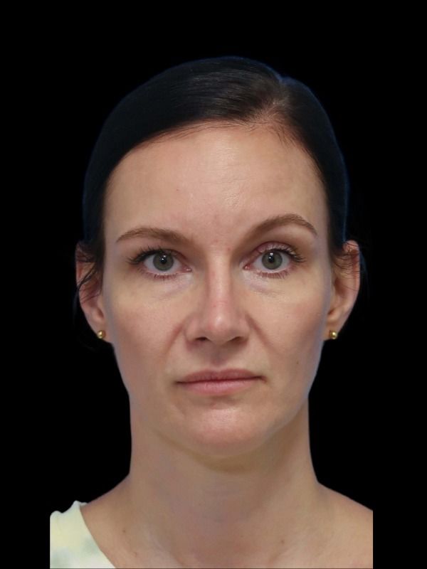 Rhinoplasty Before & After