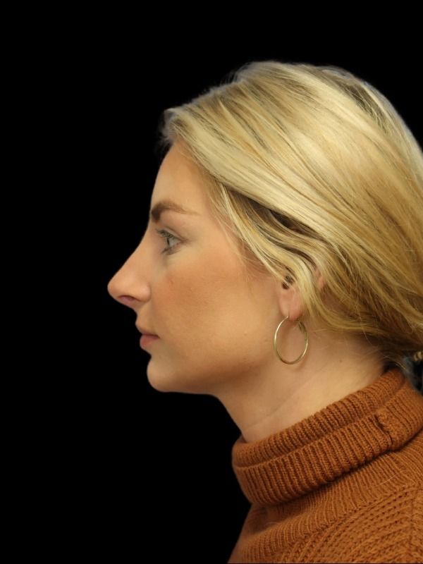 Rhinoplasty Before & After