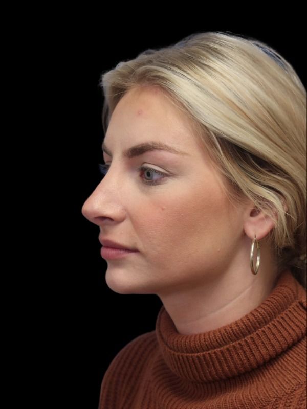 Rhinoplasty Before & After