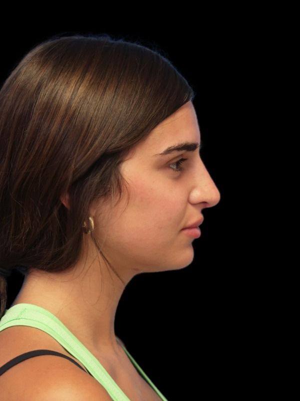 Rhinoplasty Before & After