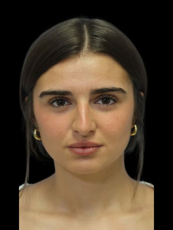 Rhinoplasty Before & After