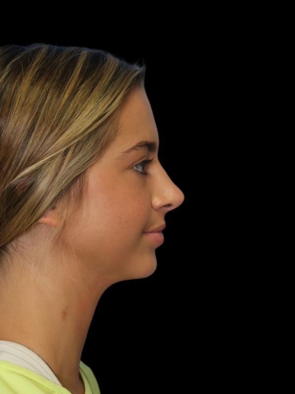 Rhinoplasty Before & After