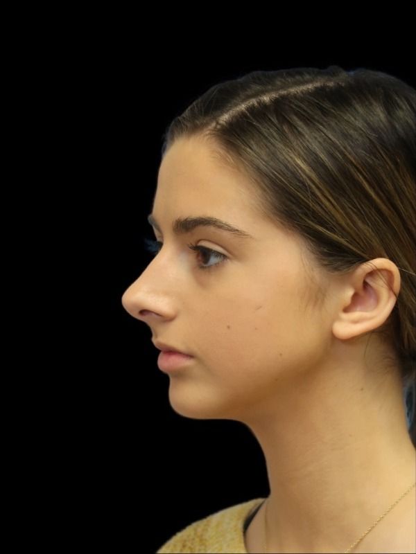 Rhinoplasty Before & After