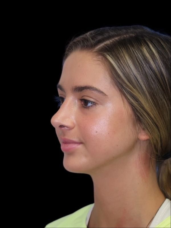 Rhinoplasty Before & After