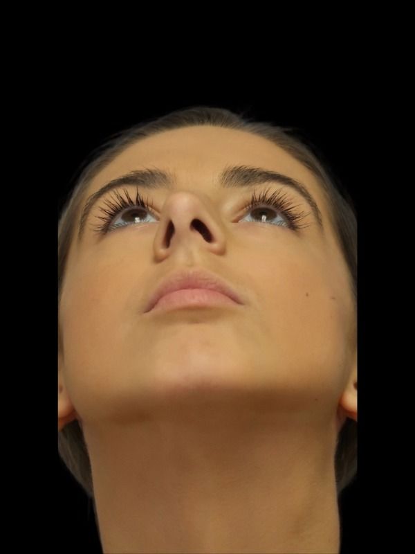 Rhinoplasty Before & After