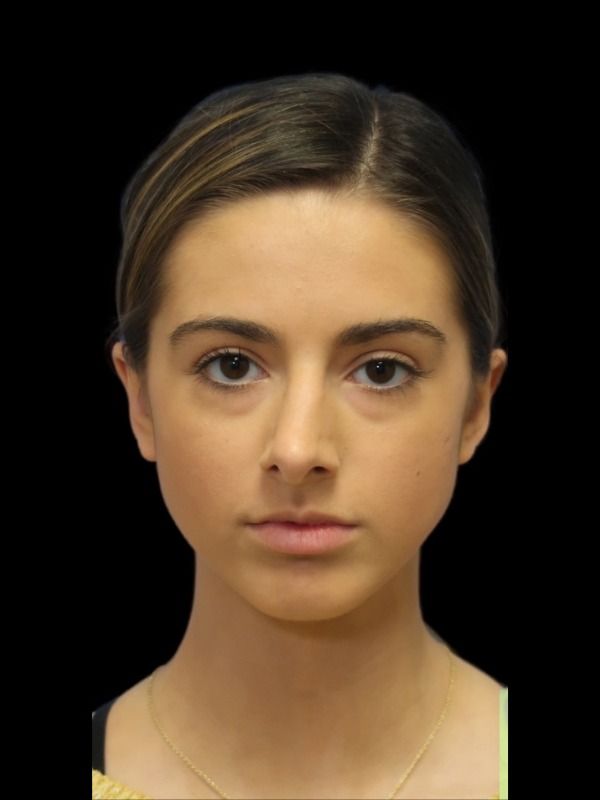 Rhinoplasty Before & After