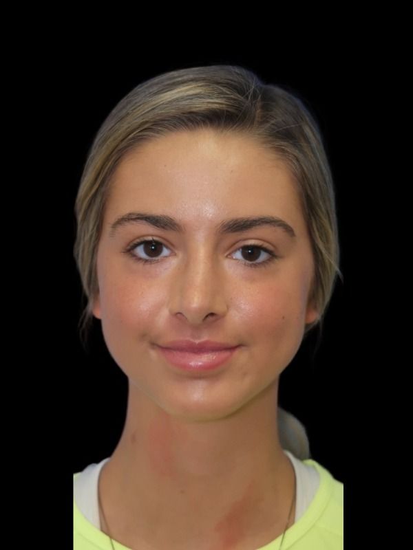 Rhinoplasty Before & After